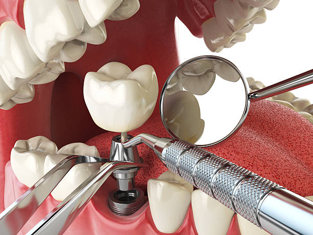 Best Emergency Wisdom Tooth Extraction in Prceton, IN